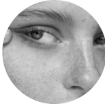 Гіперпігментація